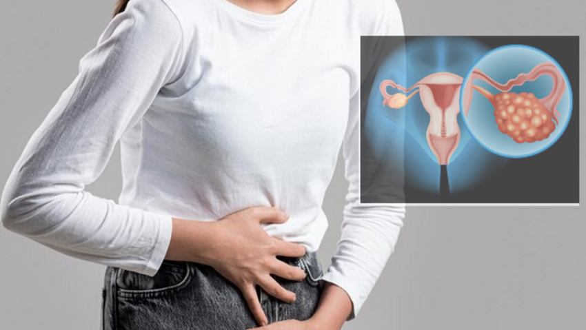 El cáncer de ovario afecta a más de 250.000 mujeres en el mundo