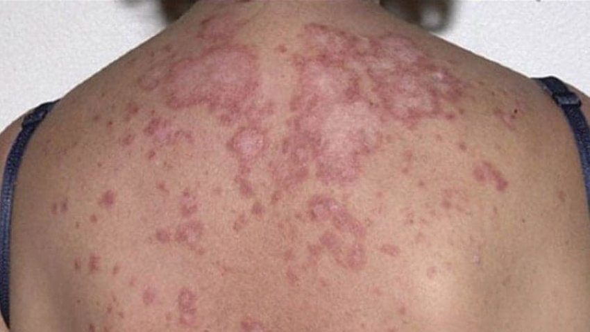 Lupus, la enfermedad autoinmune que ataca a mujeres de entre 20 y 50 años